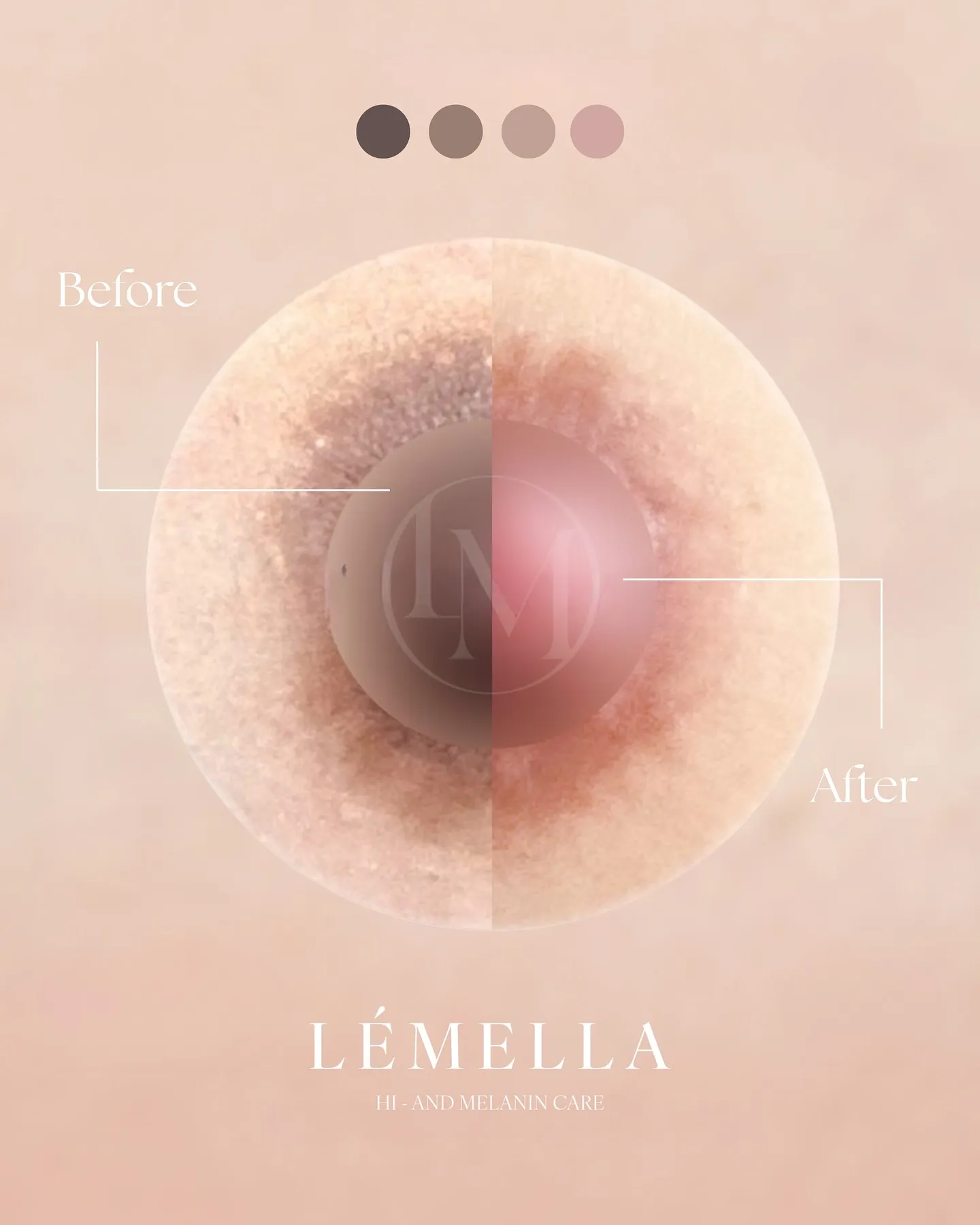 【乳輪ルメラ Before→After✨】